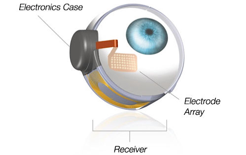 Retinal implant diagram