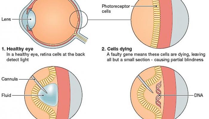 how gene therapy works