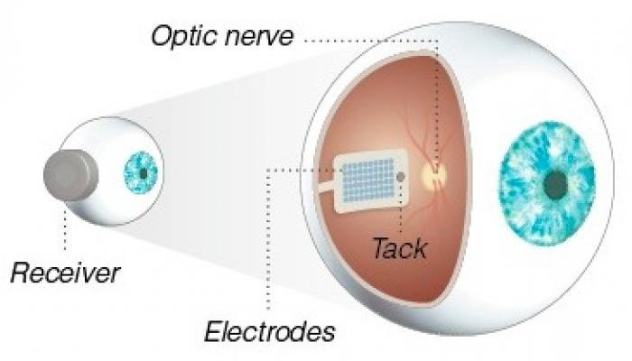 Artificial retina