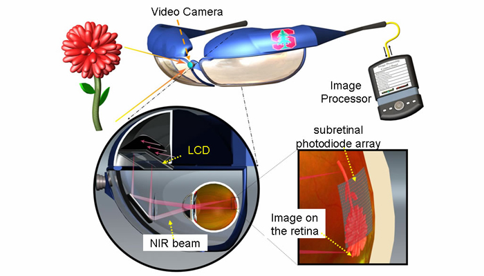 diagram of how the retinal microchip works