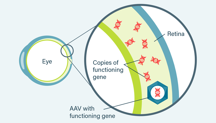 diagram of gene therapy in the retina