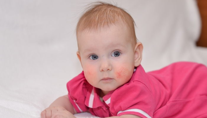 A lovely beautiful baby with an allergic rash or eczema lies on a white plaid.