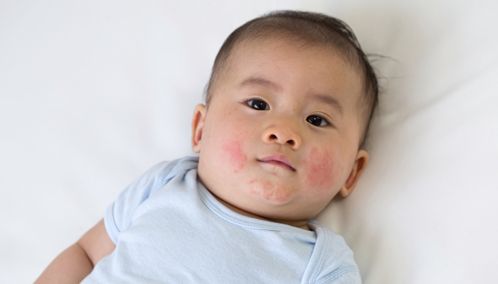 Asian baby boy lying on the bed and had a red rash on face.