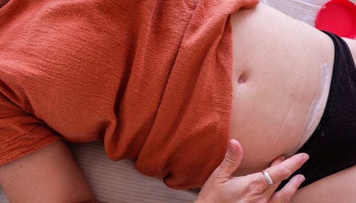 Woman with cesarean scar putting cream in the scar.