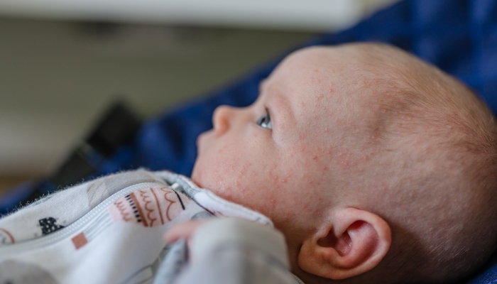 A baby with acne on his cheeks.