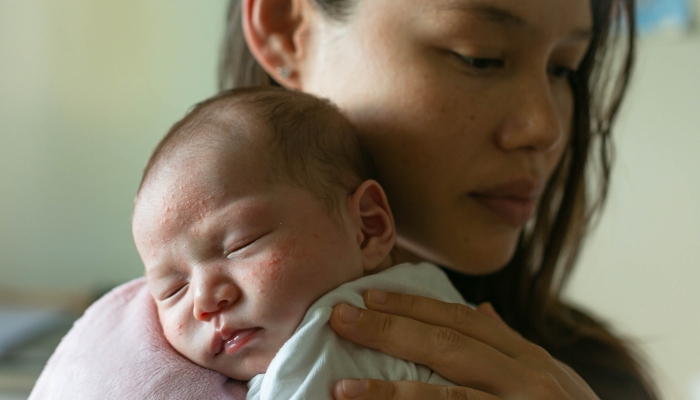 A depressed mother holding her baby with skin problems.