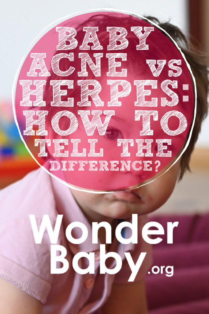 Baby Acne vs Herpes: How to Tell the Difference Pin