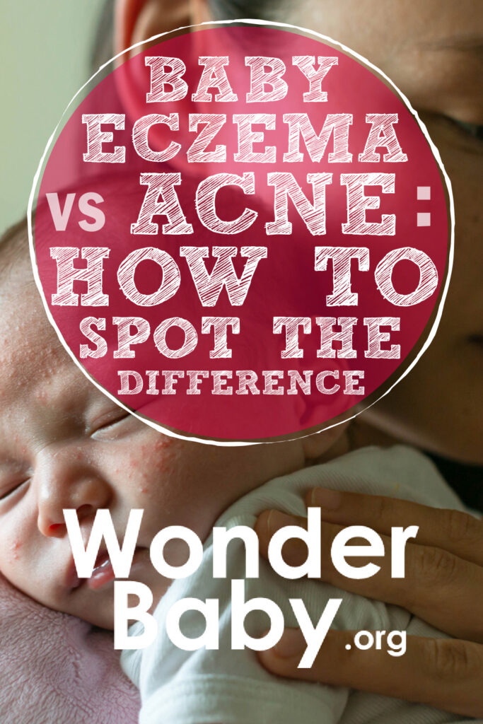 Baby Eczema vs Acne: How to Spot the Difference Pin