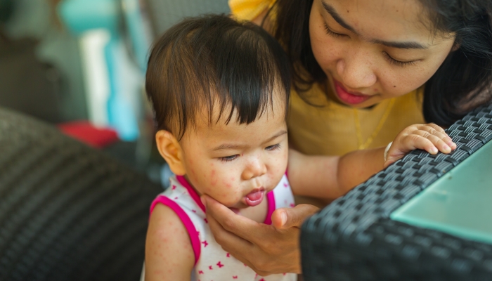 Baby has rashes on her face because she get herpes infection.