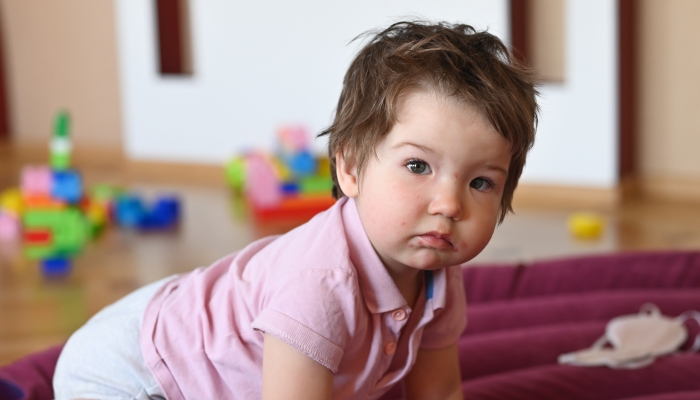 Child has sprinkled her face with herpes.