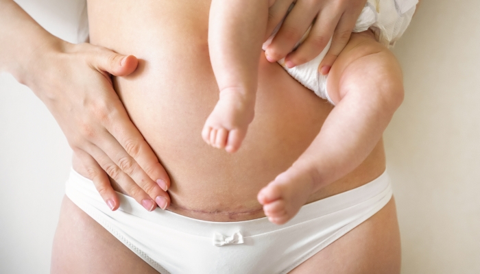 Closeup of woman belly with a scar from a cesarean section.