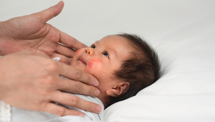 New born baby with skin acne on the cheeks.