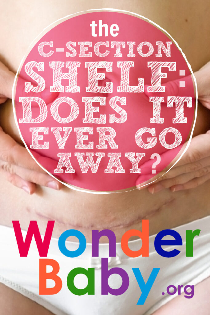 The C-Section Shelf: Does It Ever Go Away Pin