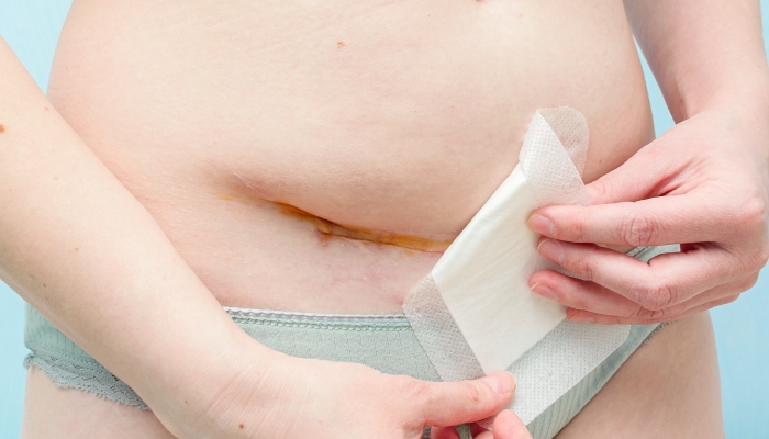Closeup of woman belly with scar from cesarean section with a medical bandage.
