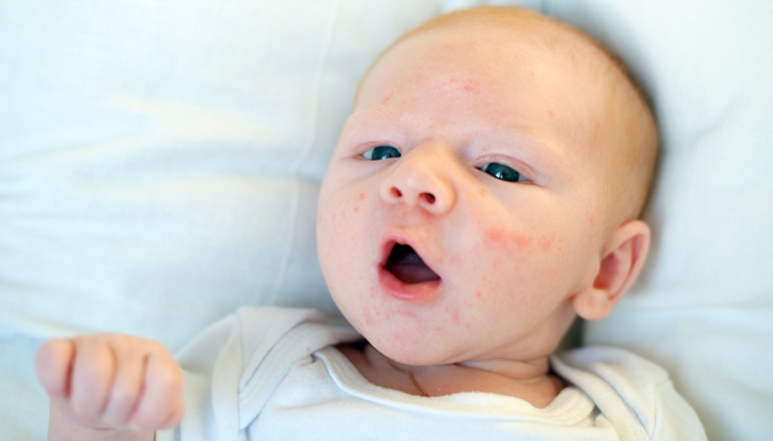 Allergies, atopic dermatitis on the face of a baby.