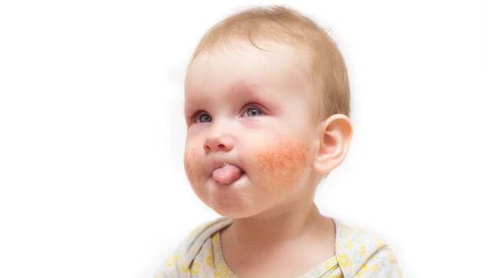 Baby allergic rash on the cheeks and near mouth.
