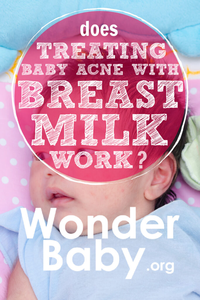 Does Treating Baby Acne With Breast Milk Work