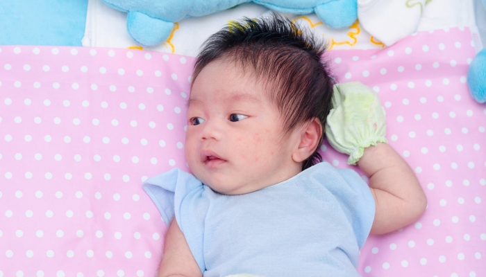 Little newborn with acne on face.