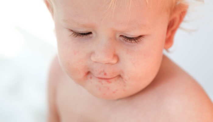 Portrait of a baby with a rash near the mouth.