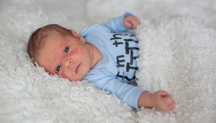 Little newborn baby looking, baby with skin acne.