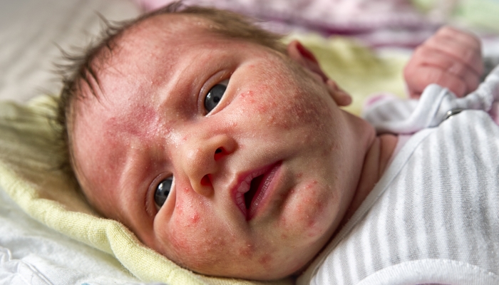 Newborn acne on face.