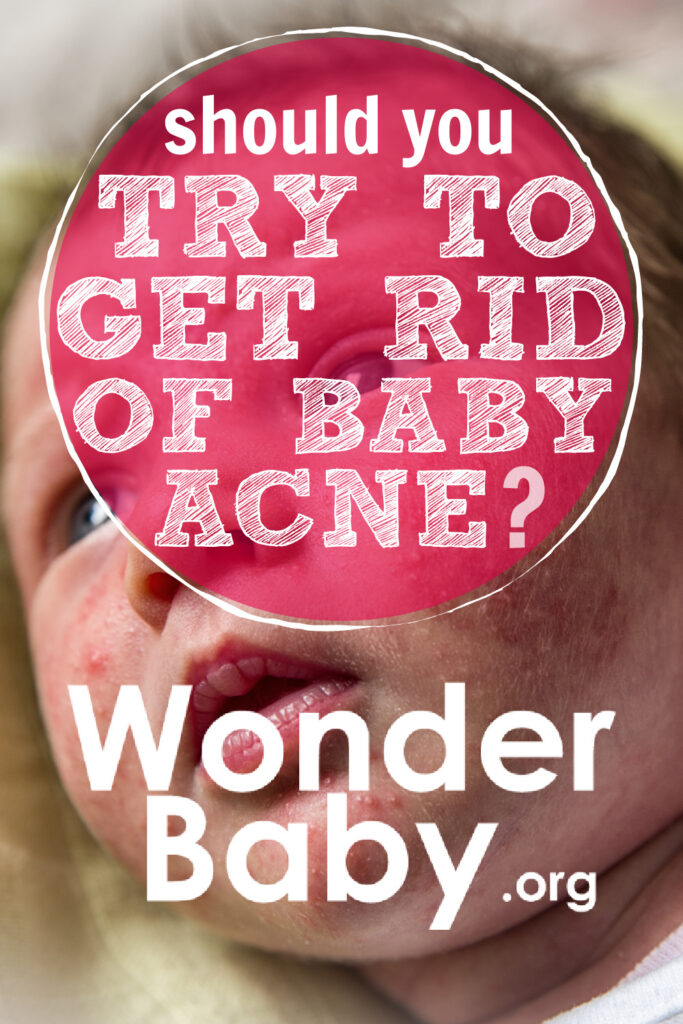 Should You Try to Get Rid of Baby Acne?