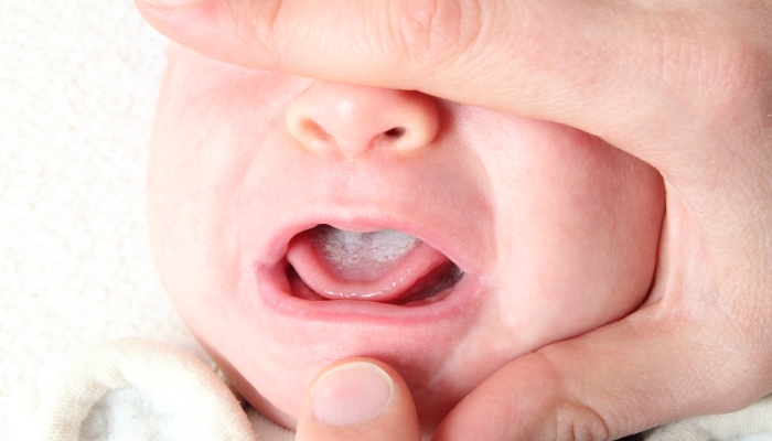 Oral thrush of a newborn baby.