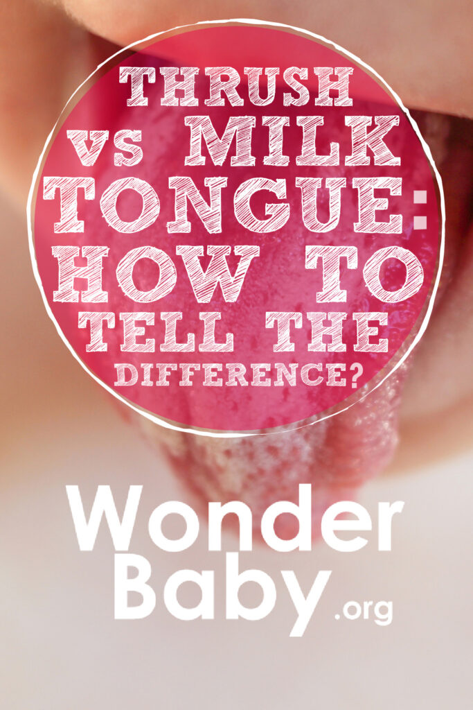 Thrush vs Milk Tongue: How to Tell the Difference