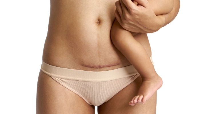 Woman belly with a scar from a cesarean section with her baby's legs on white background.