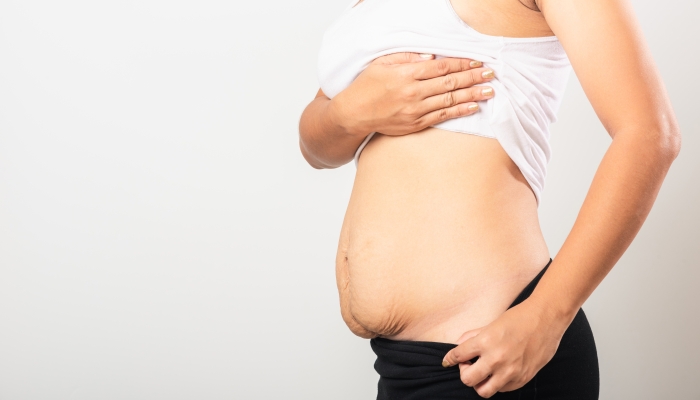 Asian mother woman showing stretch mark.