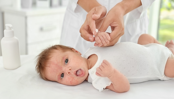 Adorable baby with skin allergy undergoing treatment.