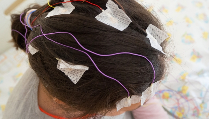 Girl with EEG electrodes attached to her head for medical test.