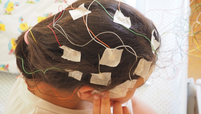 Girl with EEG electrodes attached to her head.