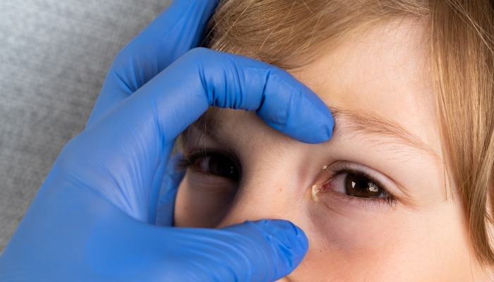 A child with red purulent eyes from conjunctivitis.