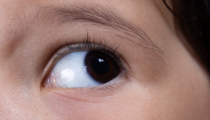 A macro view on the eye of a young child suffering from Aniridia.