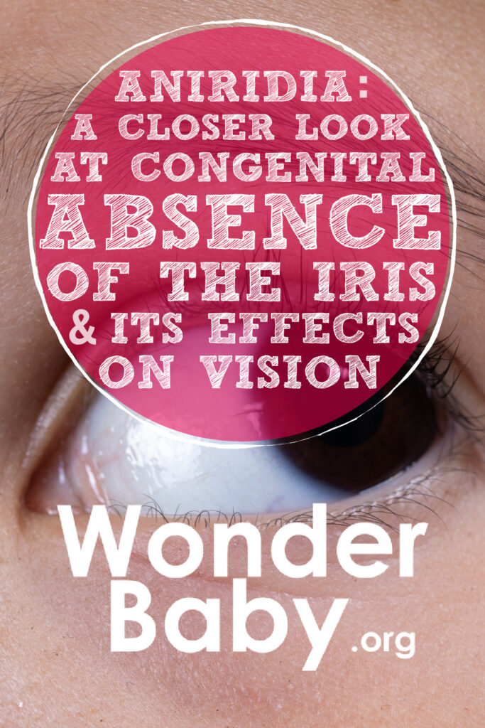 Aniridia: A Closer Look at Congenital Absence of the Iris and Its Effects on Vision