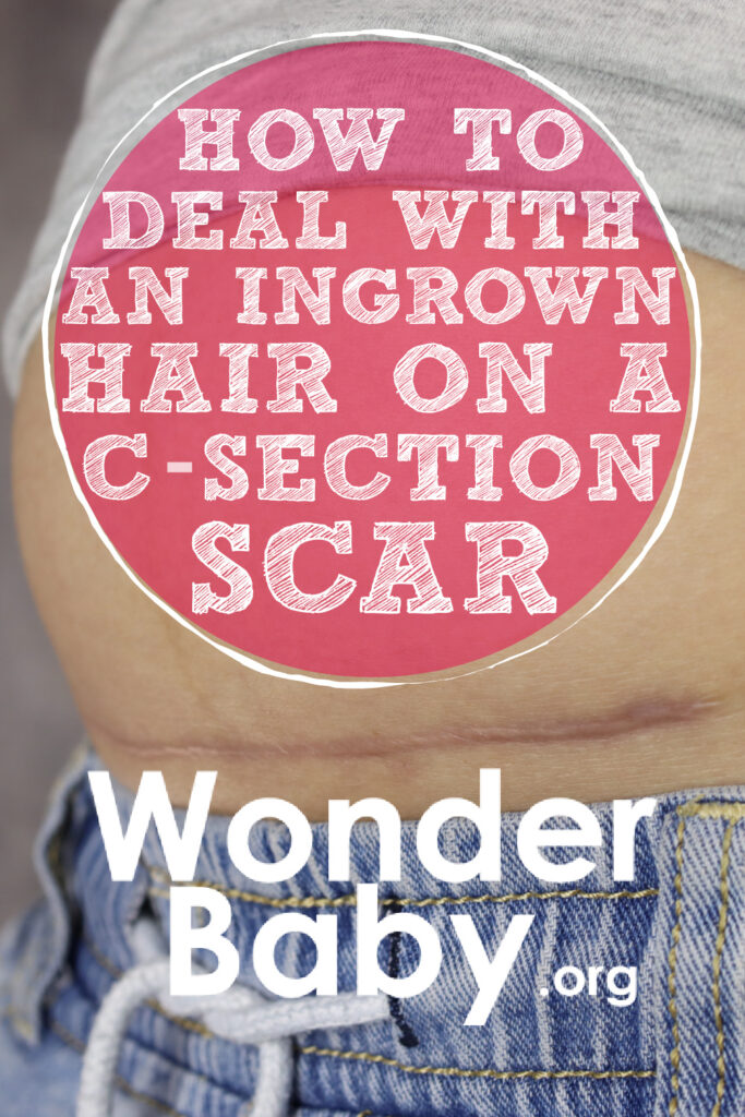 How To Deal With an Ingrown Hair on a C-Section Scar
