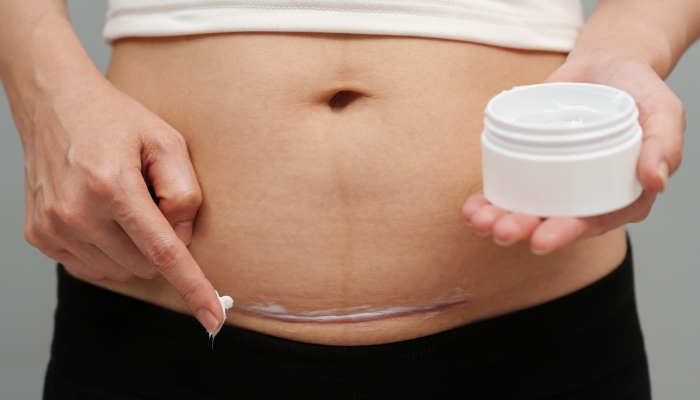 Woman putting healing cream in the c-section scar of cesarean.